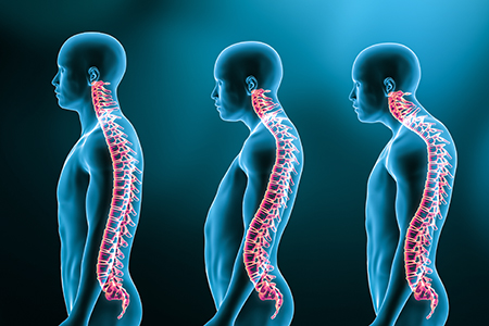 Kyphosis Treatment in Los Angeles