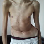 Scoliosis Treatment in Sonoma County with Dr. Dimitriy Kondrashov