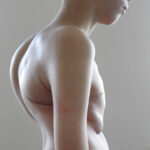 Scoliosis Treatment in Sonoma County with Dr. Dimitriy Kondrashov