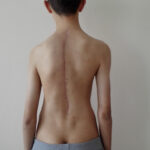 Scoliosis Treatment in Sonoma County with Dr. Dimitriy Kondrashov