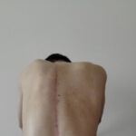 Scoliosis Treatment in Sonoma County with Dr. Dimitriy Kondrashov
