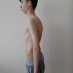 Scoliosis Treatment in Sonoma County with Dr. Dimitriy Kondrashov