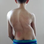 Scoliosis Treatment in Sonoma County with Dr. Dimitriy Kondrashov