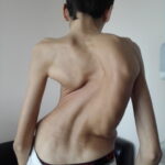 Scoliosis Treatment in Sonoma County with Dr. Dimitriy Kondrashov