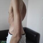 Scoliosis Treatment in Sonoma County with Dr. Dimitriy Kondrashov