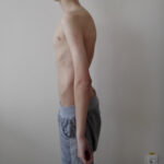 Scoliosis Treatment in Sonoma County with Dr. Dimitriy Kondrashov