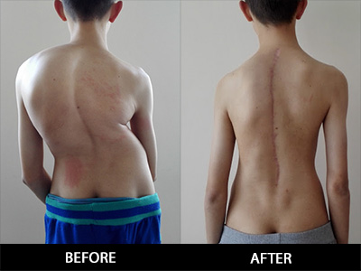 Scoliosis Treatment in Sonoma County with Dimitriy Kondrashov, MD